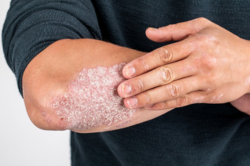 Man with sick hands, dry flaky skin on his hand with vulgar psoriasis, eczema and other skin diseases such as fungus, plaque, rash and blemishes. Autoimmune genetic disease - obrazy, fototapety, plakaty