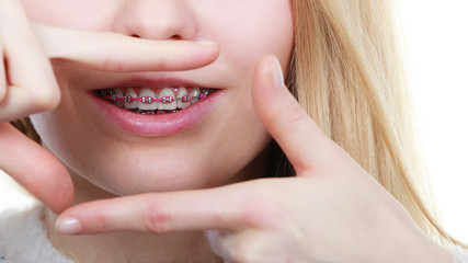 Obraz premium Happy woman showing her braces on teeth