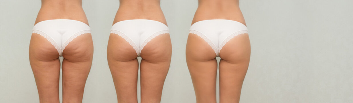 Female buttocks before and after treatment. panoramic