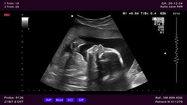 Ultrasonography of pregnant woman. Unborn baby in the womb is moving during a medical examination. Prenatal testing with ultrasound. Seamlessly loop conceptual footage