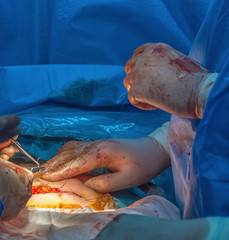 Doctor surgery team in the operating room of abdominal cesarean section during child birth.