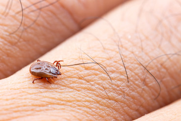 Tick filled with blood sitting on human skin.