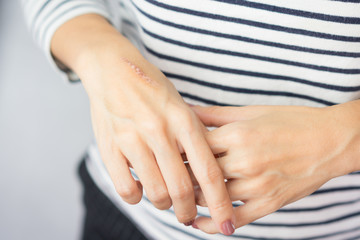 Close up of cooking oil burn scar on a woman's hands. The skin damage in first-degree on outer...