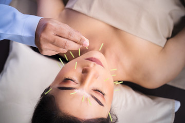 Obraz na płótnie Canvas woman undergoing acupuncture treatment on face