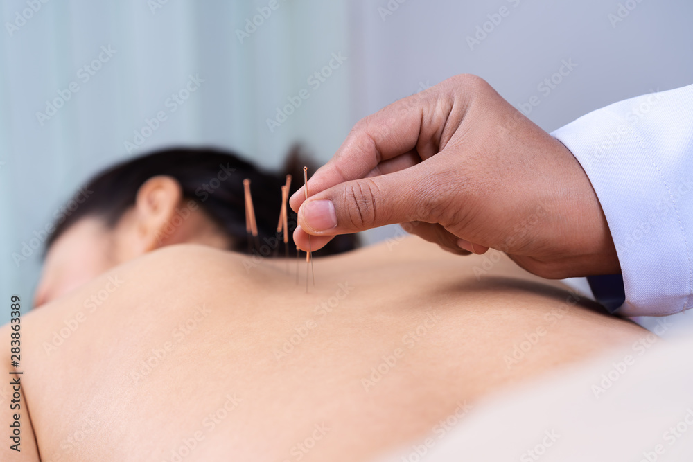 Canvas Prints woman undergoing acupuncture treatment on back