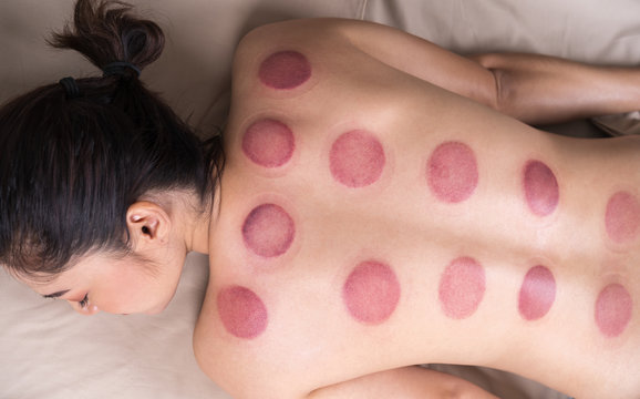 woman receiving cupping treatment on back