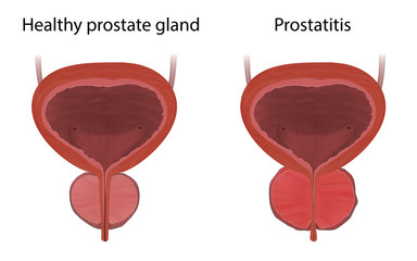 Prostatitis and healthy prostate gland, comparison. Inflammation, infection. Realistic vector medical illustration.