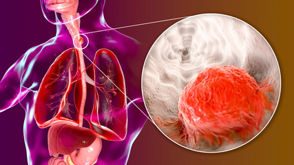 Esophageal cancer, 3D illustration showing malignant tumor in the human esophagus - obrazy, fototapety, plakaty