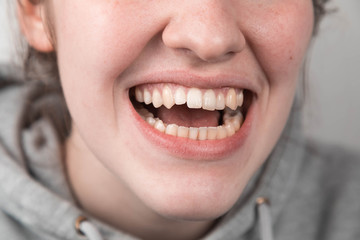 Problem teeth at the young girl. A curve row and the wrong bite an occasion to visit the dentist and the orthodontist