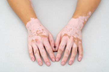 Vitiligo on skin of hands.