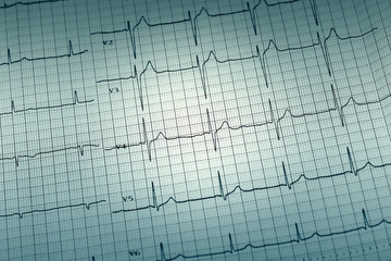 ECG paper graph report, electrocardiogram on paper form as background