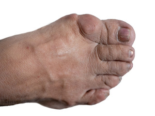 human foot with bunion big bone near hallux big finger on white background. isolated cutout image