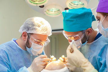 Baldness treatment. Hair transplant. Surgeons in the operating room carry out hair transplant surgery. Surgical technique that moves hair follicles from a part of the head. - obrazy, fototapety, plakaty