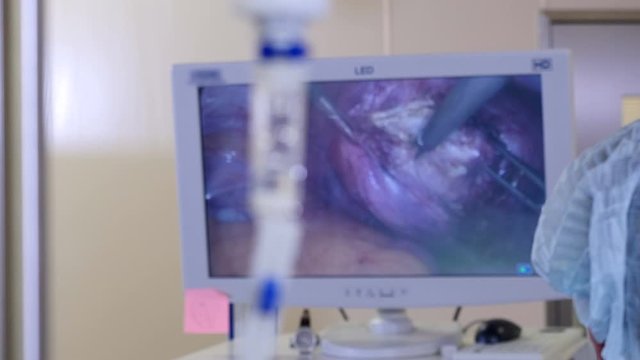 View of Intravenous drip, focus moves to monitor screen with performing laparoscopic surgery to remove uterine fibroids
