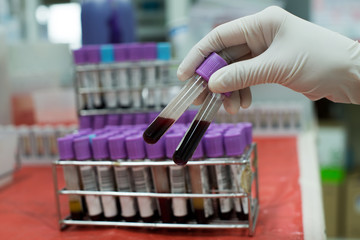 laboratory technician blood group test,malaria test