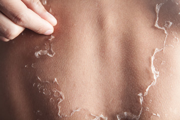 Man with peeling skin from sunburn.