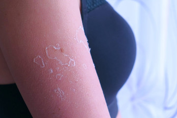 Woman with peeling skin from sunburn on shoulder, closeup. UV exposure causes sun burns and skin irritations. Burnt skin after exposing too much to the sun.