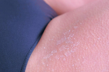 Fototapeta premium Closeup view of burnt peeling skin from UV sunburn on leg, closeup view. UV exposure causes sun burns and skin irritations. Burnt skin after exposing too much to the sun.