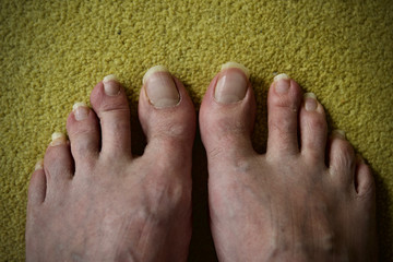 Mens feet with long toenails on yellow carpet