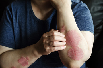 Dermatological skin disease. psoriasis, eczema, dermatitis, allergies. Skin lesions on the elbows.