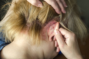 Dermatological skin disease. psoriasis, eczema, dermatitis, allergies. Skin lesions on the head.