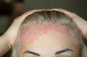 Dermatological skin disease. psoriasis, eczema, dermatitis, allergies. Skin lesions on the head.