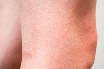 カミソリ負けして赤くなった男性の脚