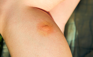 Mosquito bite on the leg. Insects in the summer. Dangerous nature. Itchy body.