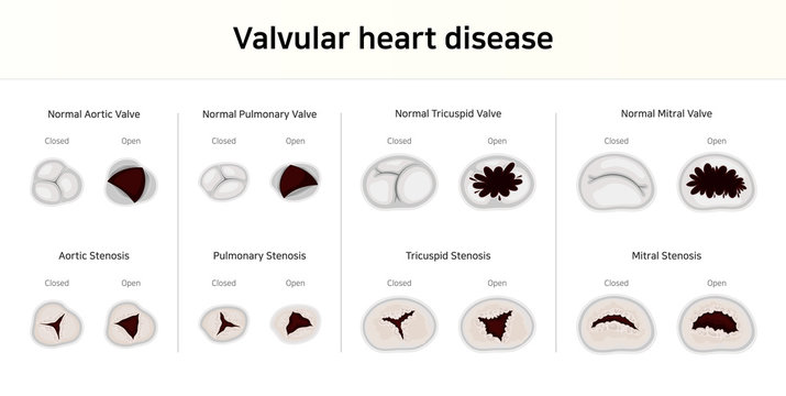 Valvular heart disease. valvular stenosis