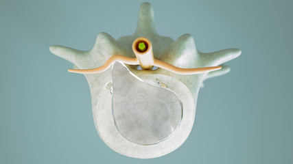 Spinal disc herniation as close-up as 3D Rendering