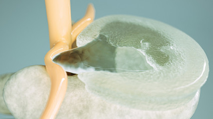 Spinal disc herniation as close-up as 3D Rendering