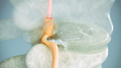 Spinal disc herniation as close-up as 3D Rendering