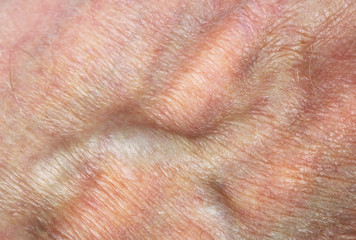 Bloated vein with blood and wrinkled  dry skin on an elderly man’s arm macro