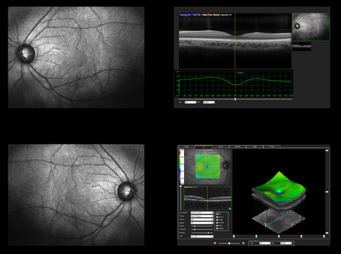 Ophthalmic test - OCT optical coherence tomography measurement. Scan of the macula in retina, layers and thickness of retina.