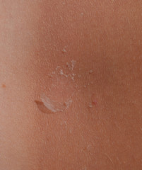 Fototapeta premium Sunburn on the skin of the back. Exfoliation, skin peels off. Dangerous sun tan