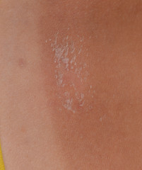 Fototapeta premium Sunburn on the skin of the back. Exfoliation, skin peels off. Dangerous sun tan