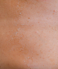 Fototapeta premium Sunburn on the skin of the back. Exfoliation, skin peels off. Dangerous sun tan