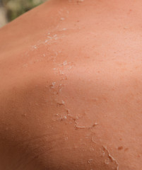 Sunburn on the skin of the back. Exfoliation, skin peels off. Dangerous sun tan