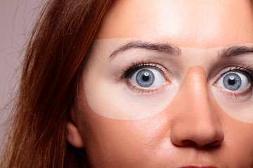 Woman with sunburn under sunglasses