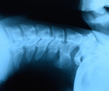 X-ray of the cervical vertebrae. X ray image of the cervical spine.