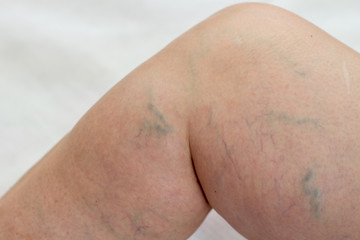 patient with varicose veins on legs