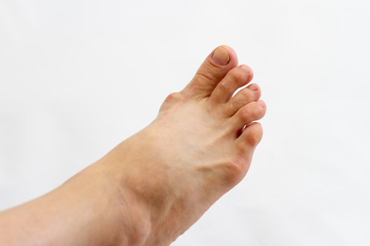 foot with gout on the bones