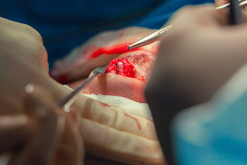 Surgeon and his assistant performing cosmetic surgery on nose in hospital operating room. Nose...