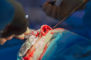 Surgeon and his assistant performing cosmetic surgery on nose in hospital operating room. Nose reshaping, augmentation. Rhinoplasty.