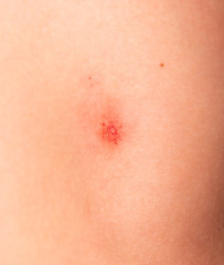 Fototapeta premium scratches on the skin of a child