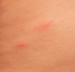 scratches on the skin of a child