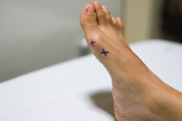 A doctor mark an Asian girl's feet Hallux Valgus before and after Proximal phalanx osteotomies.