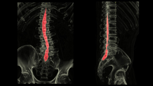 CT 3D SCAN of spinal cord in AP & lateral view with tranparent bone technic. CT myelogram L-S spine.