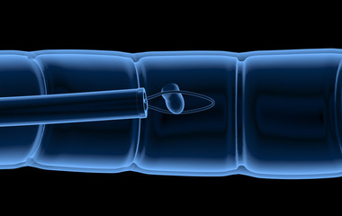 x-ray polyp removal