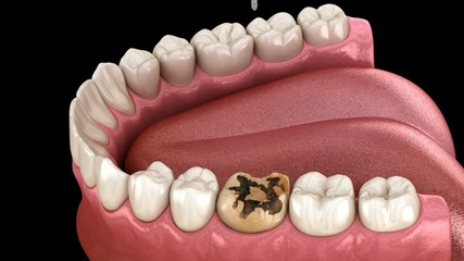 Caries removing process, preparation, crown placement. Medically accurate tooth 3D animation.